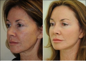 Stem Cell Face lift before and after