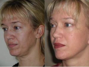 Stem cell face lift before and after