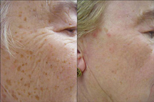 IPL-before-and-after for blog IPL- Intese Pulse Light before and after